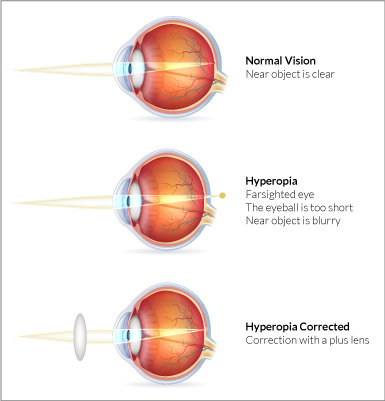 Hyperopia