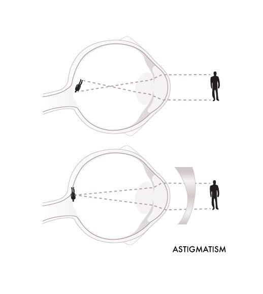 Glassesgallery lens info image - Astigmatism