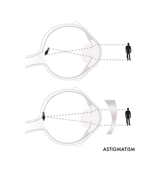Glassesgallery lens info image - Astigmatism