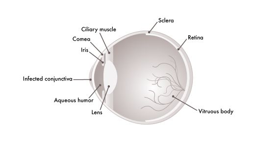 Glassesgallery lens info image - Conjunctivitis