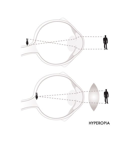 Glassesgallery lens info image - Hyperipoa