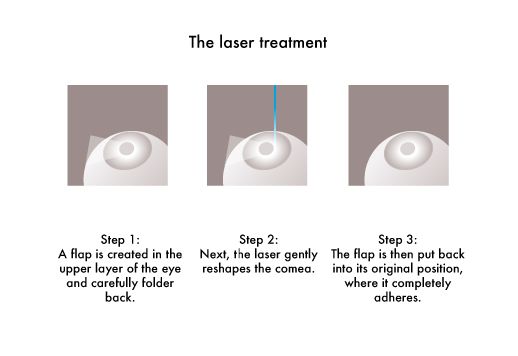Glassesgallery lens info image - Vision health laser