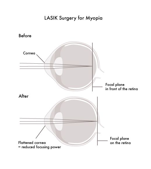 Glassesgallery lens info image - Vision health lasik