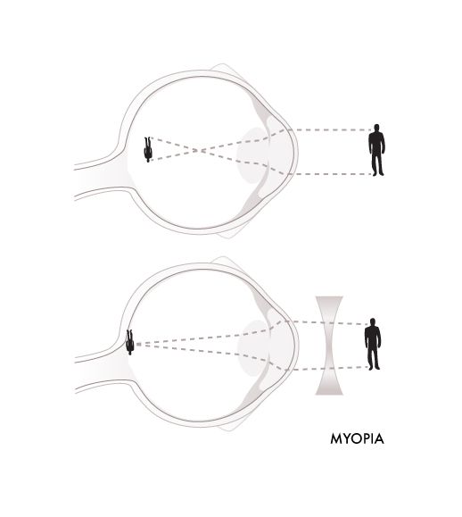 Glassesgallery lens info image - Myopia