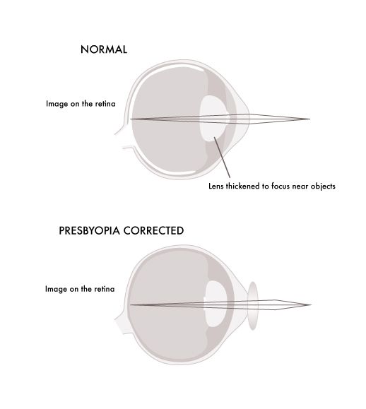 Glassesgallery lens info image - Presbyopia
